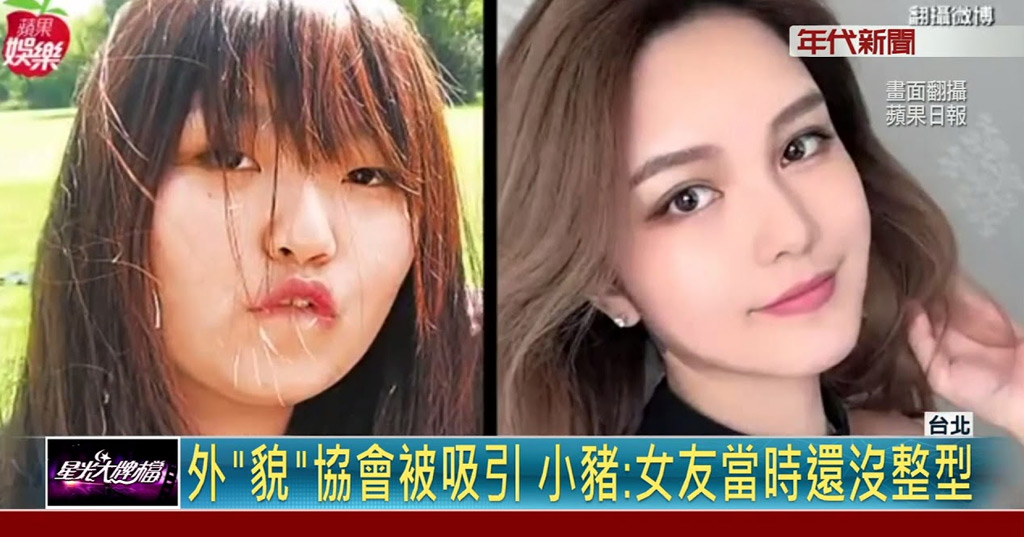 藝人整形懶人包 名人與藝人整形風波 圖多慎入 小豬愷樂周揚青都曾涉入 恆麗整型醫美診所 自體脂肪隆乳 豐胸 減肥 微創抽脂 音波拉皮 隆鼻