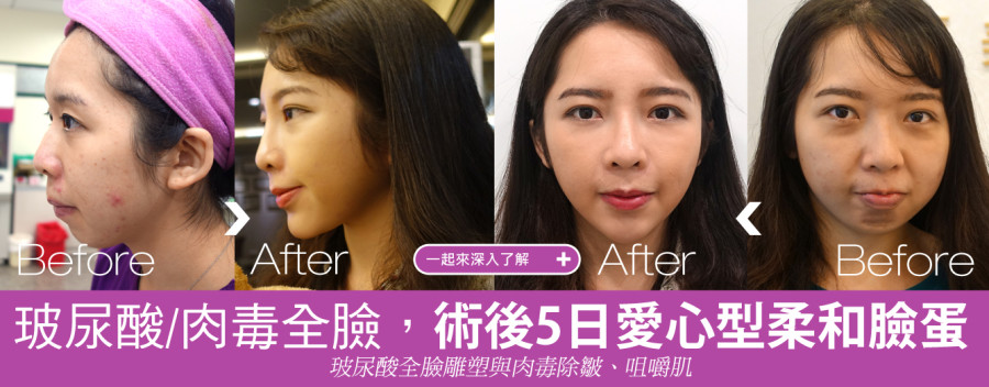 瑞絲朗玻尿酸整形實錄