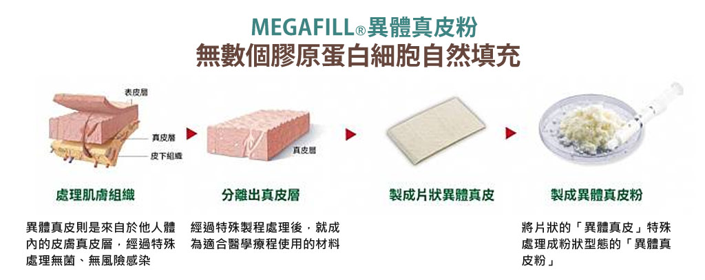 MegaFill_異體真皮_異體真皮粉_微整形_美嘉膚_04