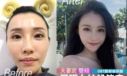 【OBT女神玻尿酸案例】柔韌型高延展性的動態修容