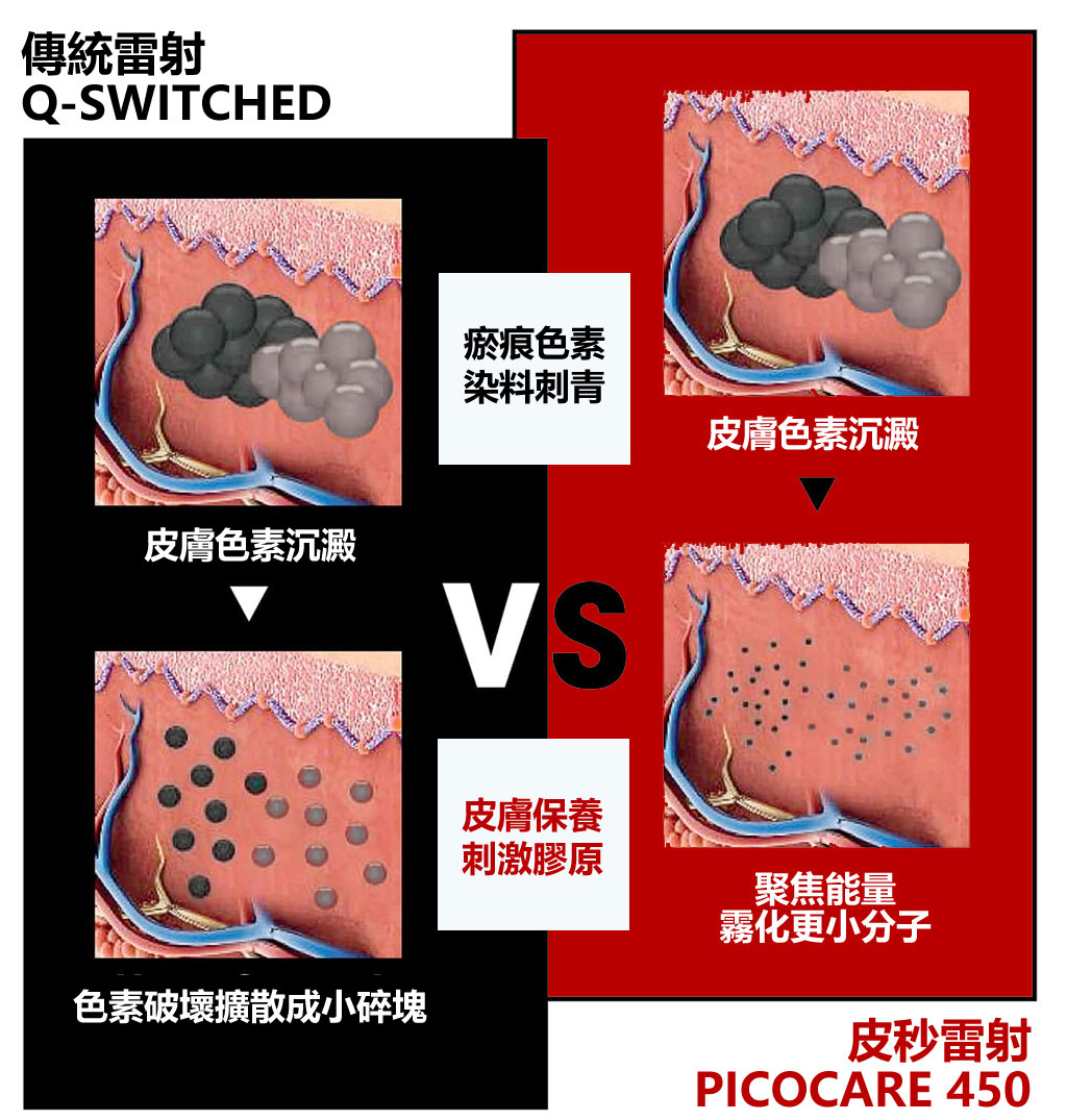 picocare皮秒雷射_蜂巢雷射_皮秒痘疤_皮秒疤痕淡化_斑點治療_皮秒斑點_03