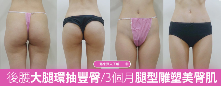 大腿抽脂/自體豐臀