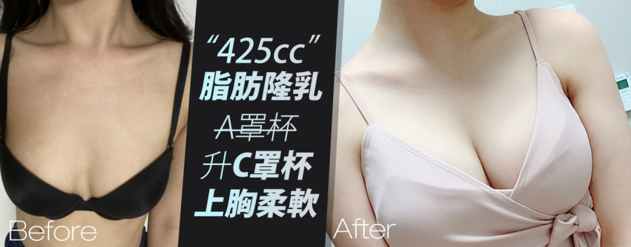 自體脂肪隆乳