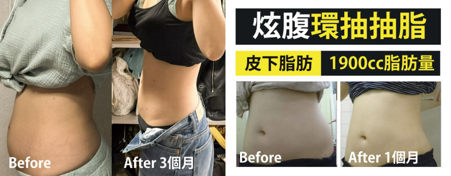 炫腹脂肪腹部雕塑