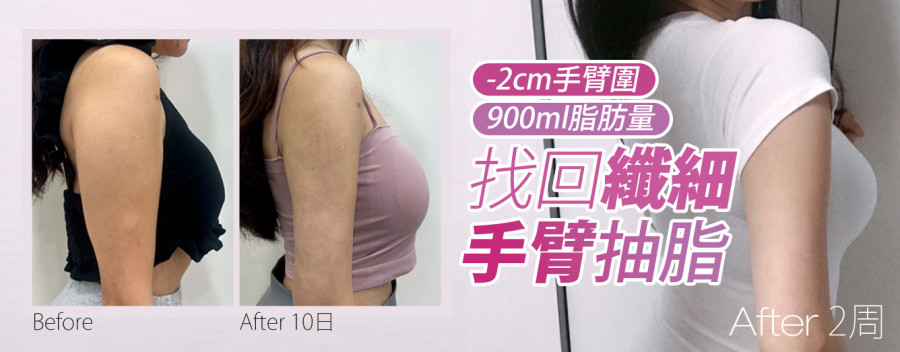 抽脂手臂