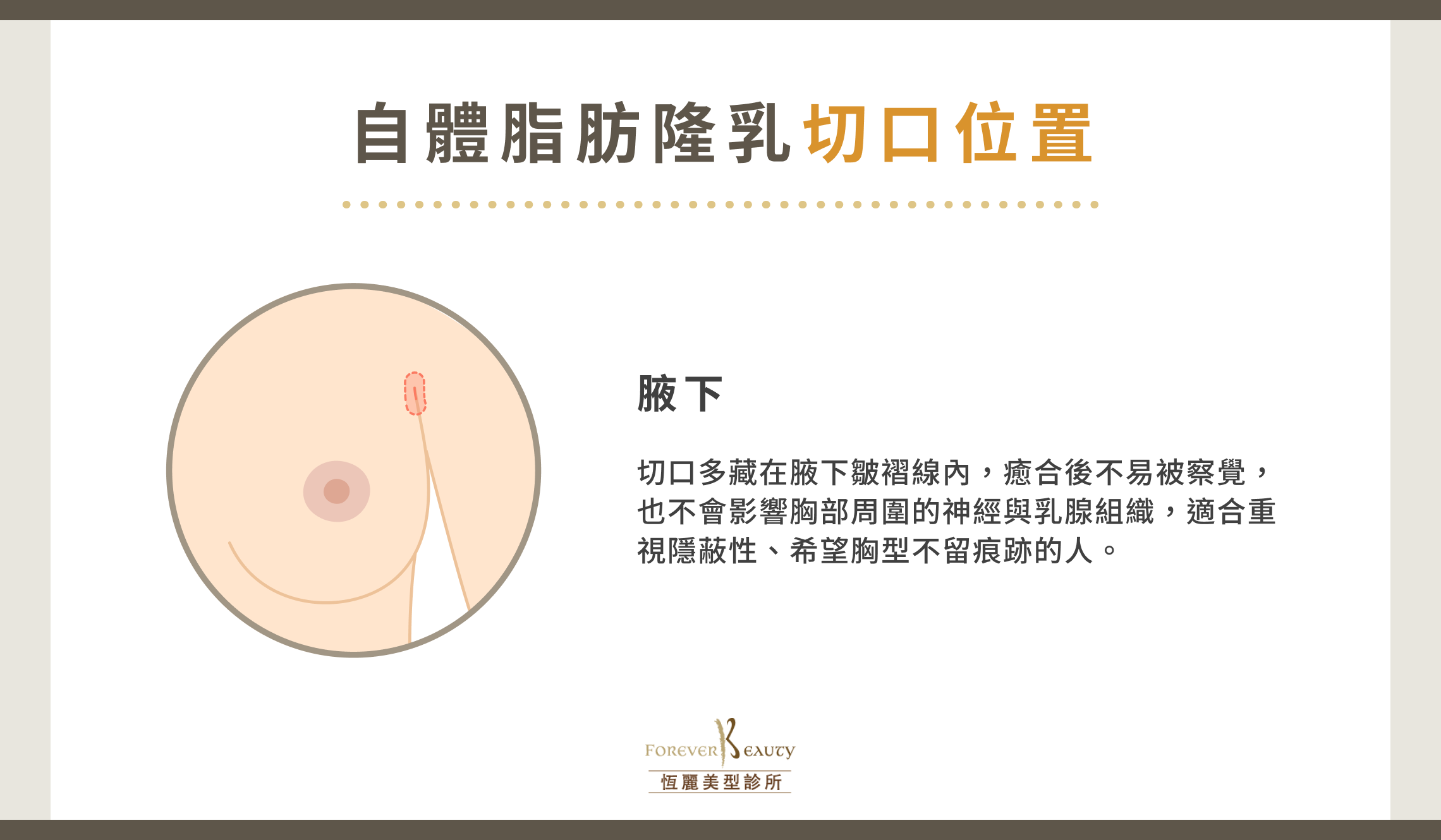 自體脂肪隆乳切口位置:腋下