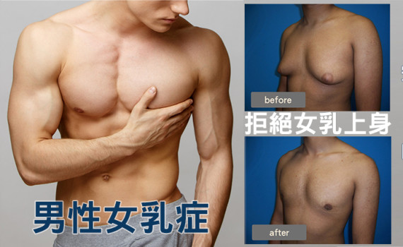 男性女乳症 微創手術就解決