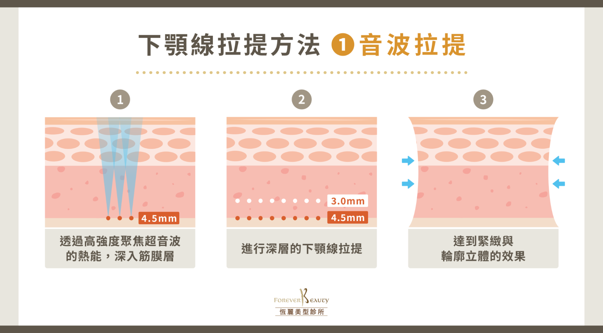 下顎線拉提方法 1:音波拉提