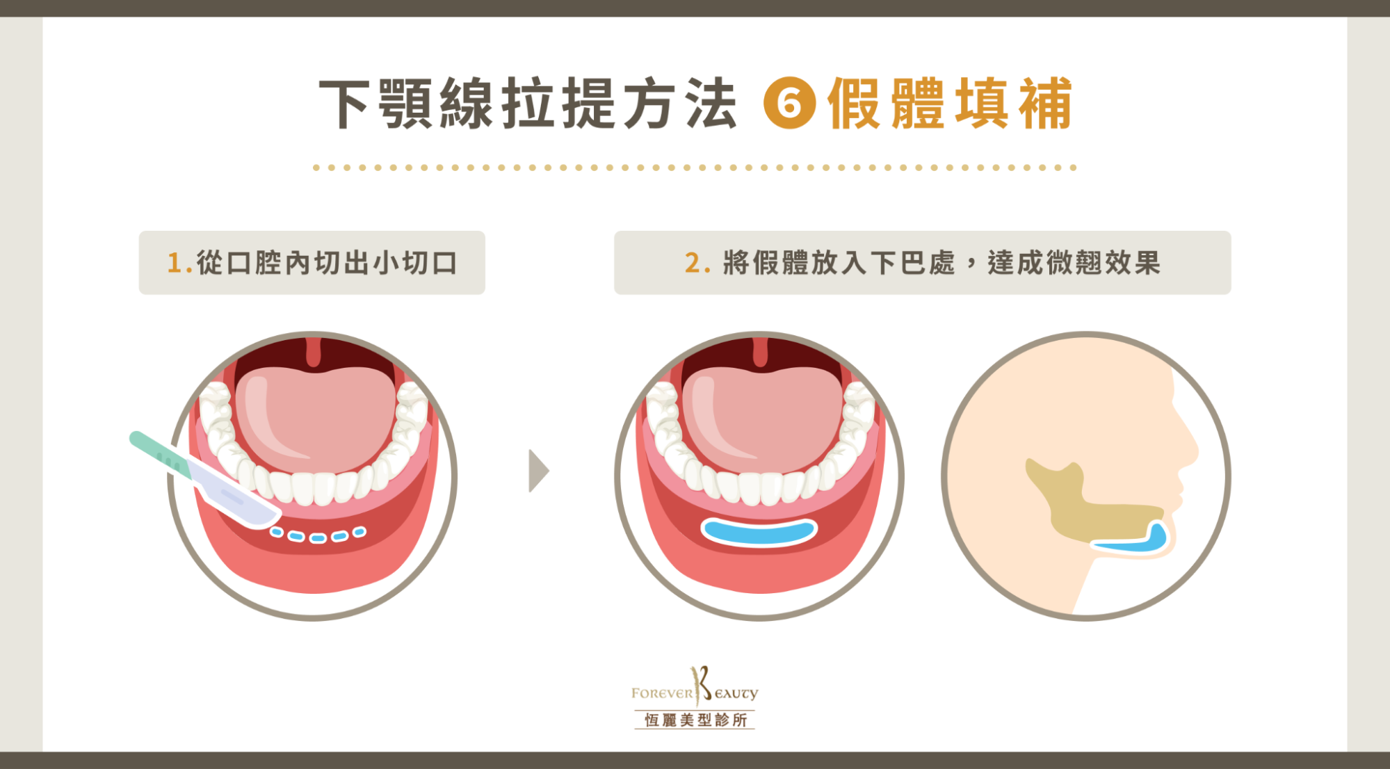 下顎線拉提方法 6:假體填補