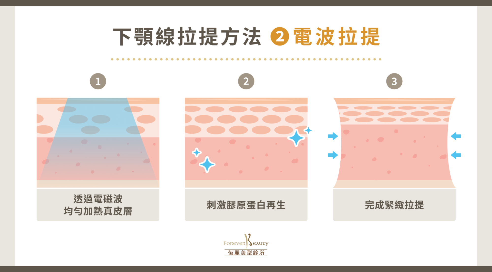 下顎線拉提方法 2:電波拉提