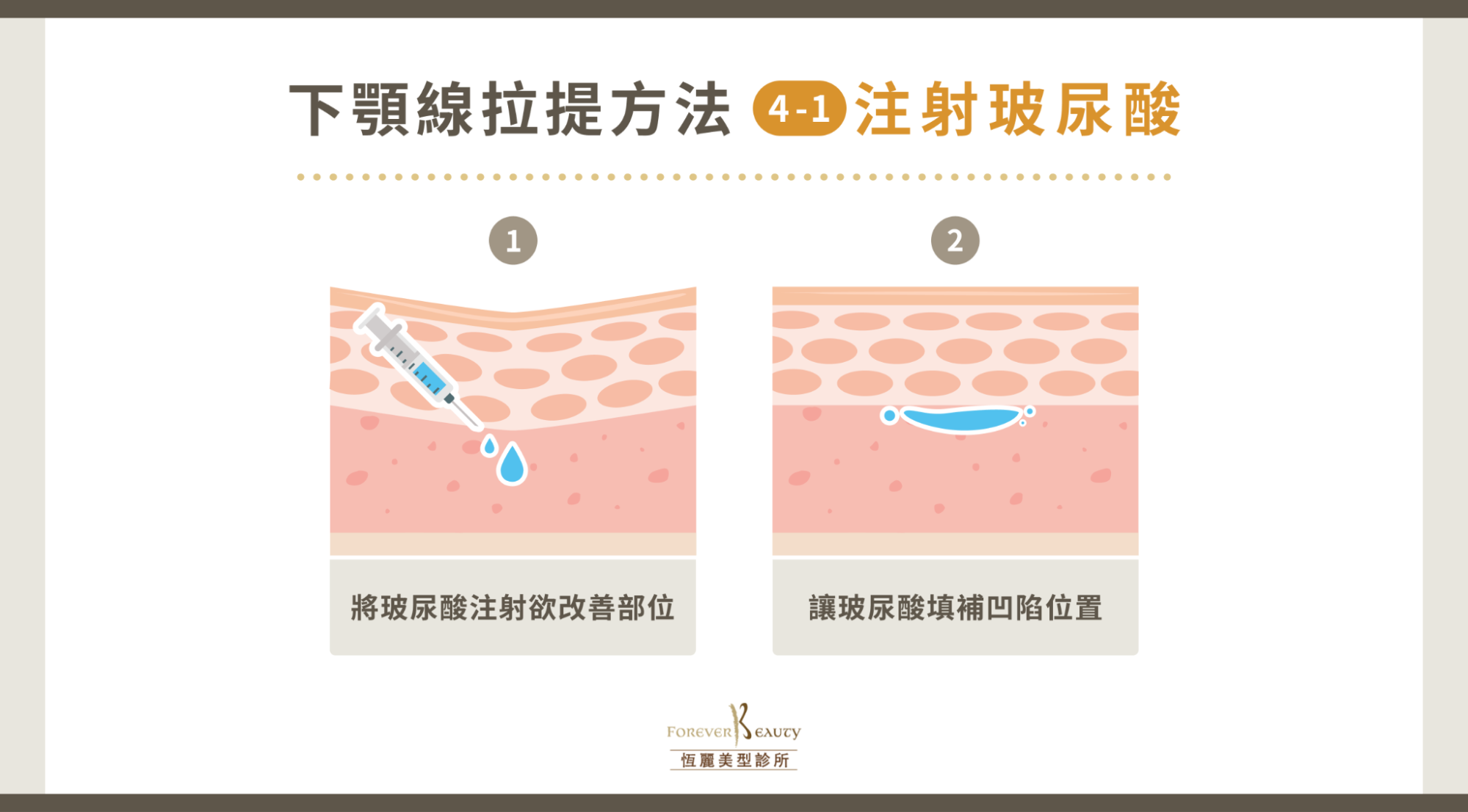 下顎線拉提方法 4:注射玻尿酸
