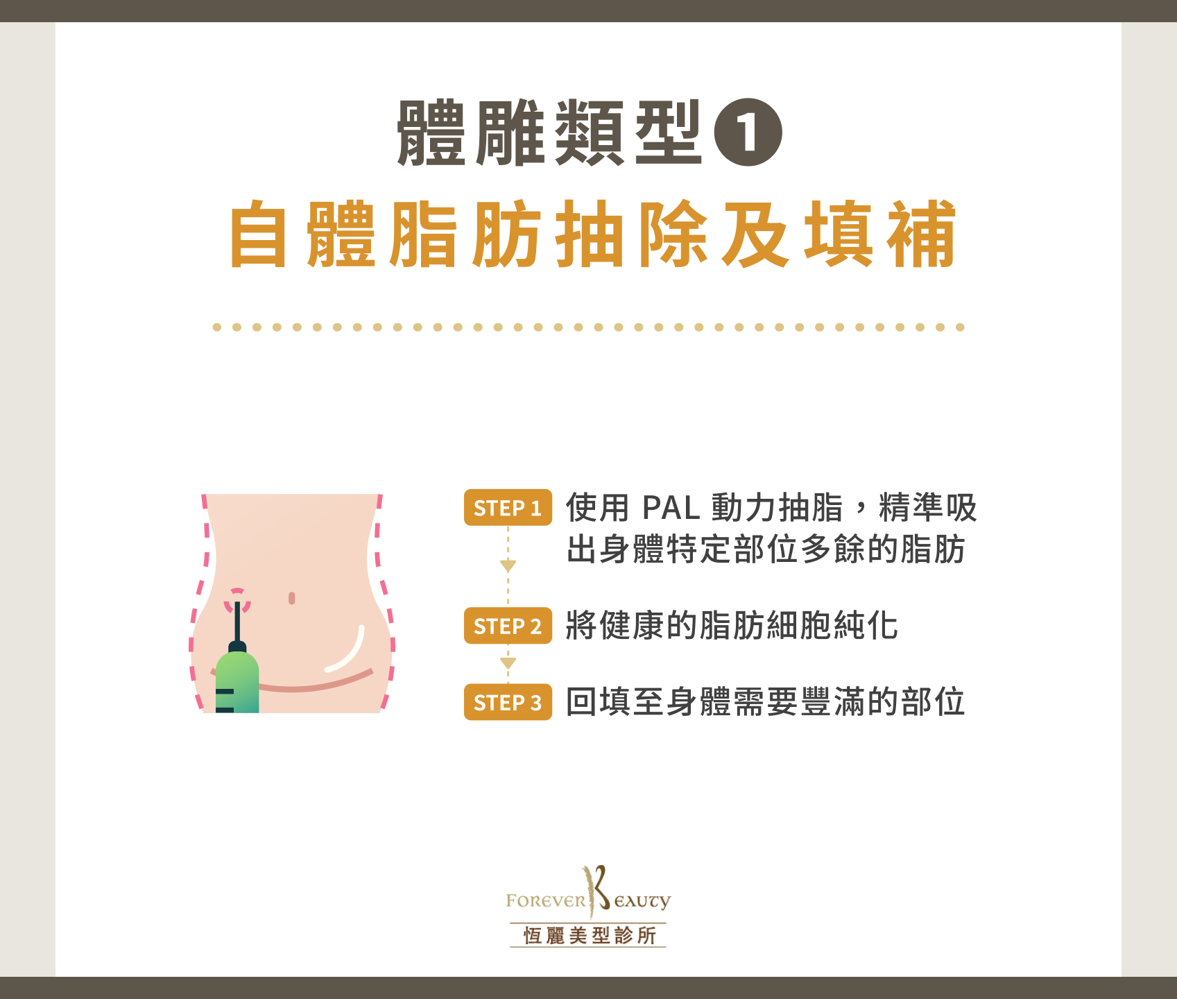 體雕類型 1:自體脂肪抽除及填補